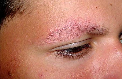 keratosis pilaris on the eyebrows