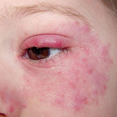 eczema around the eyes
