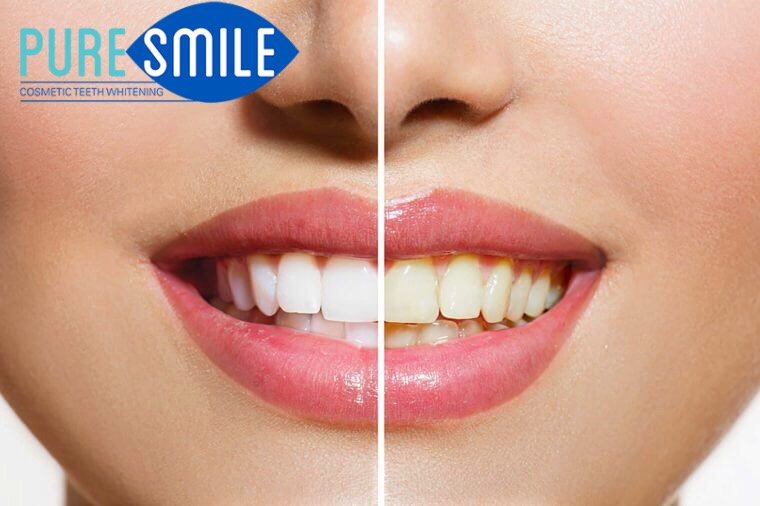 cosmetic teeth whitening in Adelaide - Pure Smile treatment
