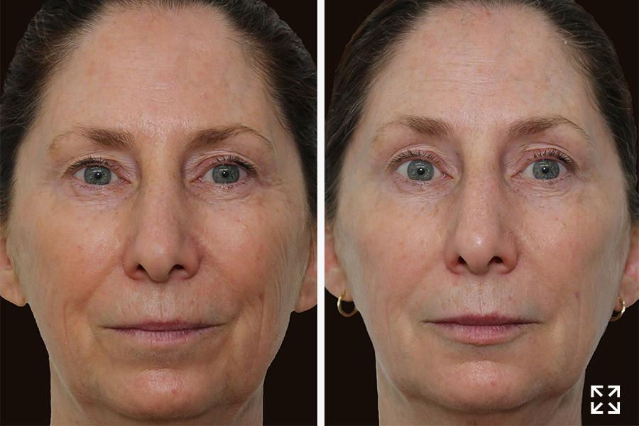 Before and after model using AGE DEFYING MULTICOMPLEX (30ML) - RETINOL