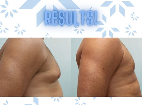 Fat Freezing Man Boobs