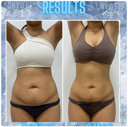 Cryofit Results