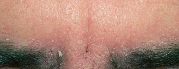 psoriasis above the eyebrows