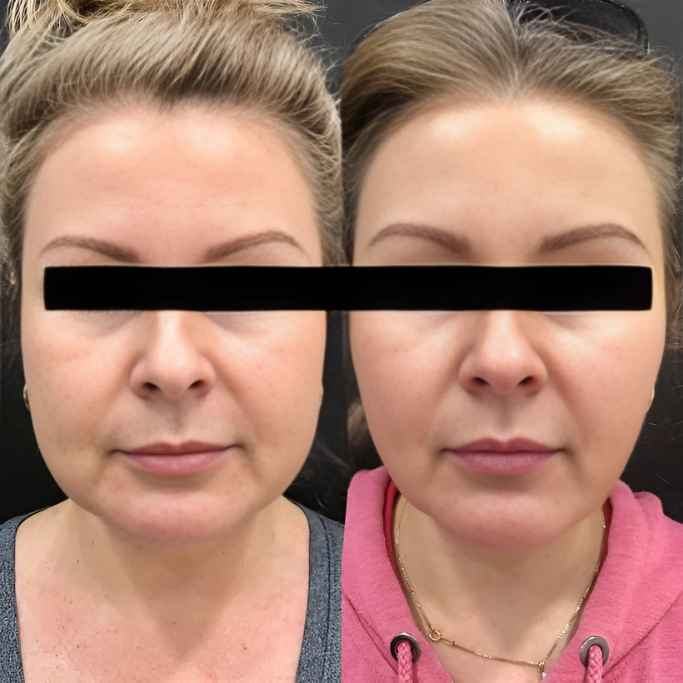Lower Face Lift