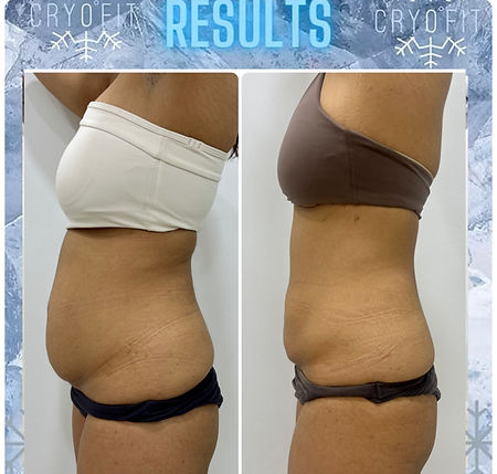Cryofit Results_edited.jpg