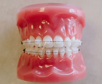 Clear Braces in Carmel, IN I Clear Braces Carmel I Carmel Orthodontist