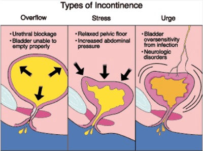 types of incontinence