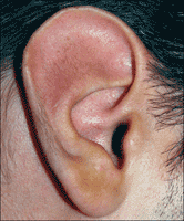 This is an ear that could not support a helix fold- theres no fold to speak of!