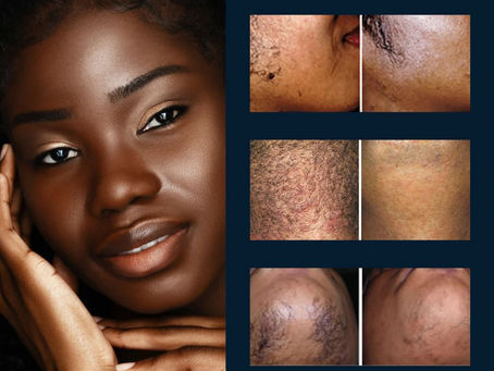Laser Hair Removal for Darker Skin Tones: What You Need to Know Before You Book