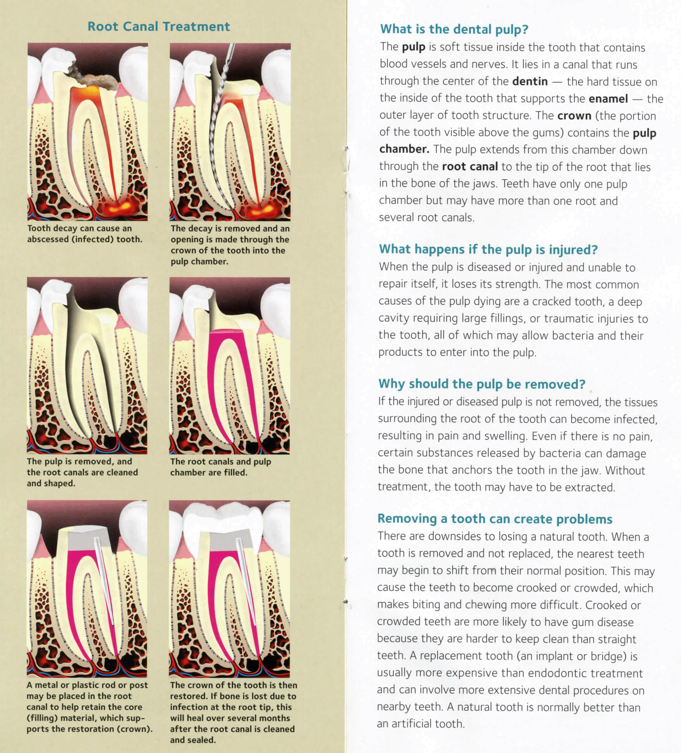 Root canals (4).gif