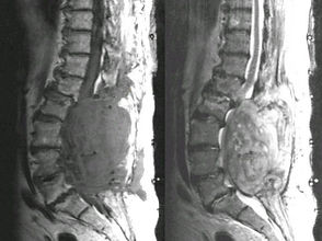 spinal hematoma.jpg