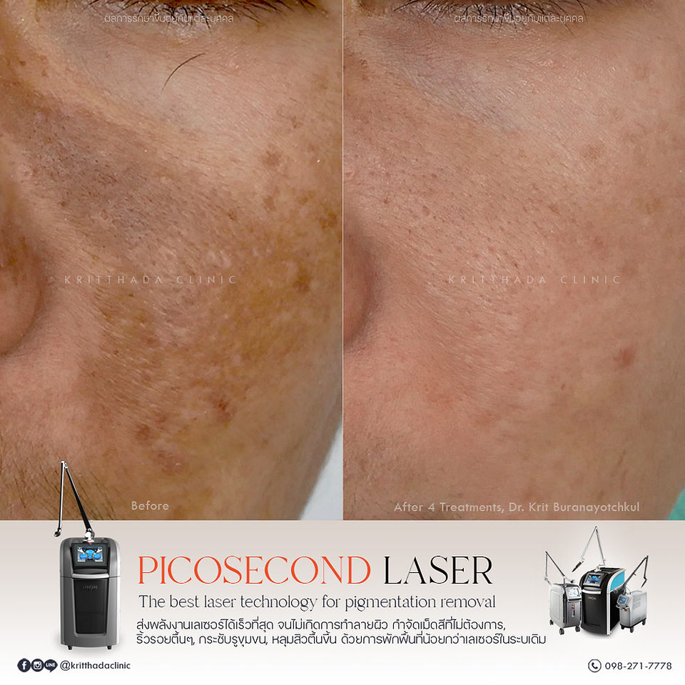 รักษาฝ้าดื้อ picosure pro เลเซอร์ ก่อน-หลัง 4 ครั้ง กริตธาดาคลินิก บางนา