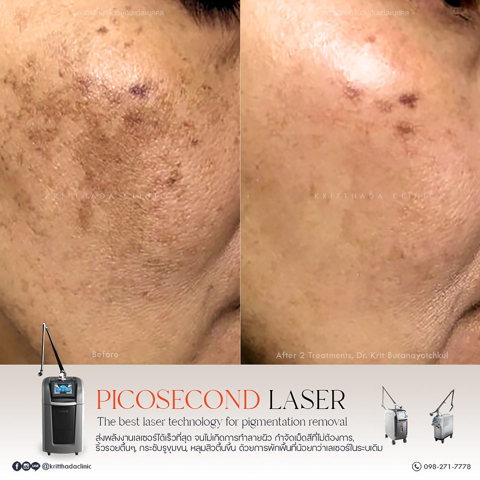 เลเซอร์ฝ้าหน้าใส picosure pro รีวิว ก่อนหลัง 2 ครั้ง กริตธาดาคลินิก