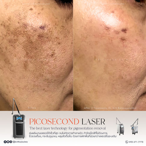 รีวิว รักษาฝ้า ด้วยเลเซอร์ PicoSure Pro ที่กริตธาดาคลินิก