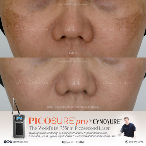 รีวิวผลลัพธ์จาก Picosure pro laser 755nm และ Combine กับเลเซอร์อื่นๆที่ Kritthada Clinic
