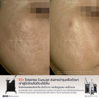 รีวิวรักษาหลุมสิวด้วย CureJet Juvelook ก่อนและหลังทำ ผิวเรียบเนียนขึ้นชัดเจน