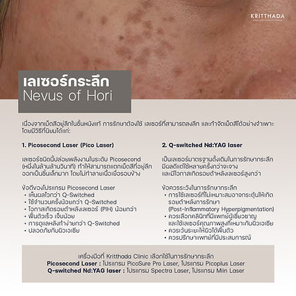 เลเซอร์รักษากระลึก มีอะไรบ้าง ที่ Kritthada Clinic บางนา