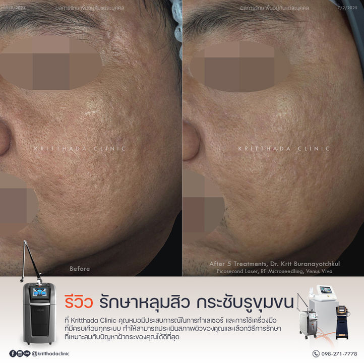 รีวิว รักษาหลุมสิว Kritthada Clinic