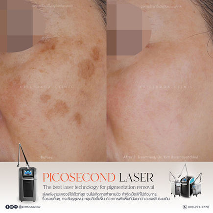 ภาพเปรียบเทียบก่อนและหลังเลเซอร์รักษากระแดด Solar Lentigo บริเวณหน้าแก้ม หลังทำ 1 ครั้ง ด้วยเครื่อง PicoSure Pro Laser ที่ Kritthada Clinic บางนา