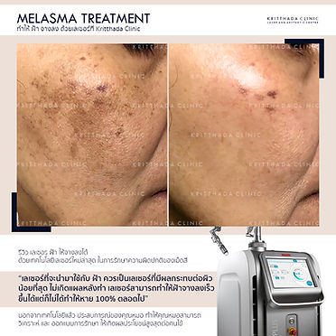 PICOSURE รีวิว รักษาฝ้า