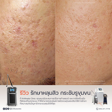 ภาพเปรียบเทียบก่อนและหลังการรักษาหลุมสิวและกระชับรูขุมขน เผยให้เห็นผิวที่เรียบเนียนขึ้น ที่ Kritthada Clinic ย่านบางนา