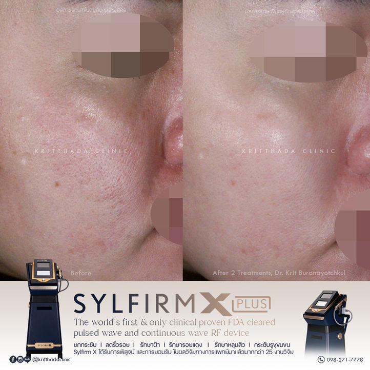 รีวิว Sylfirm X Plus รักษาหลุมสิว กระชับรูขุมขน Kritthada Clinic