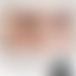 รีวิว Picosure Laser รักษากระตื้น Freckles I Kritthada Clinic