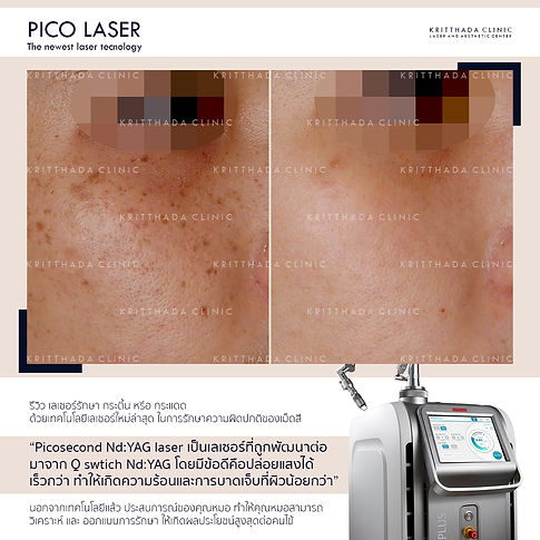 รีวิว pico เลเซอร์