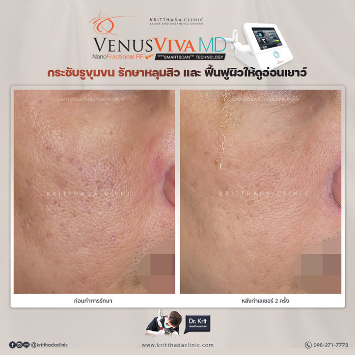รีวิว Venus Viva MD รักษาหลุมสิว 