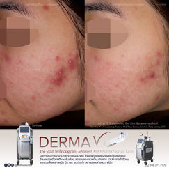ภาพรีวิวก่อนและหลังรักษารอยแดง สิวอักเสบ ด้วยเครื่องเลเซอร์ Derma V Laser ที่ Kritthada Clinic บางนา