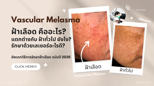 ฝ้าเลือด คืออะไร? เจาะลึกสาเหตุ ส่องลักษณะอาการและวิธีรักษาฝ้าเลือด อัปเดตปี 2026