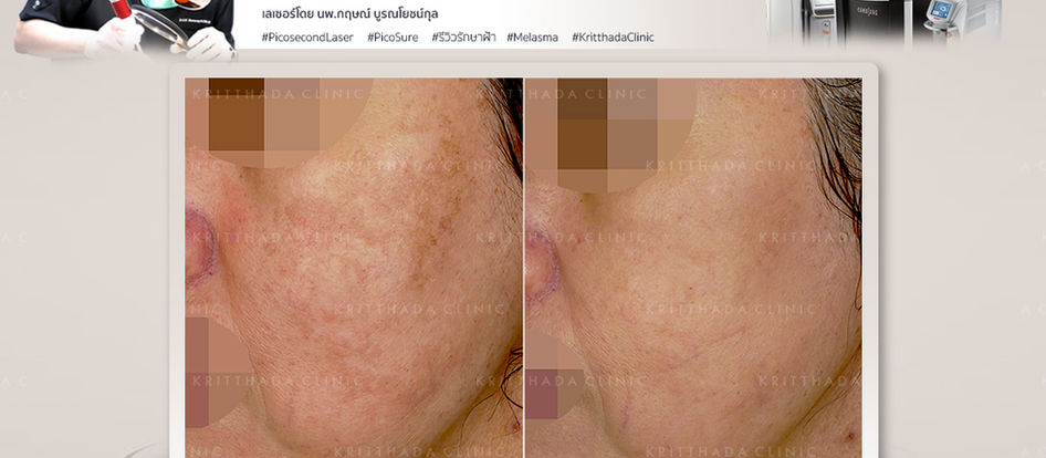 PICOSURE LASER รักษาฝ้า ทำให้ฝ้าจางลงได้หรือไม่?