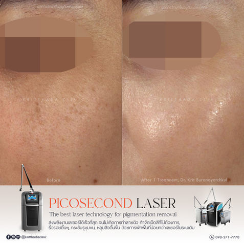 เปรียบเทียบผลการรักษากระและปรับสีผิวหน้าให้สม่ำเสมอด้วยเลเซอร์ PicoSure Pro