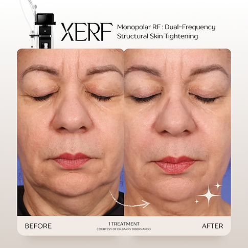 รีวิว XERF ยกกระชับปรับรูปหน้าให้ละมุน 2 คลื่นความถี่ Kritthada Clinic บางนา