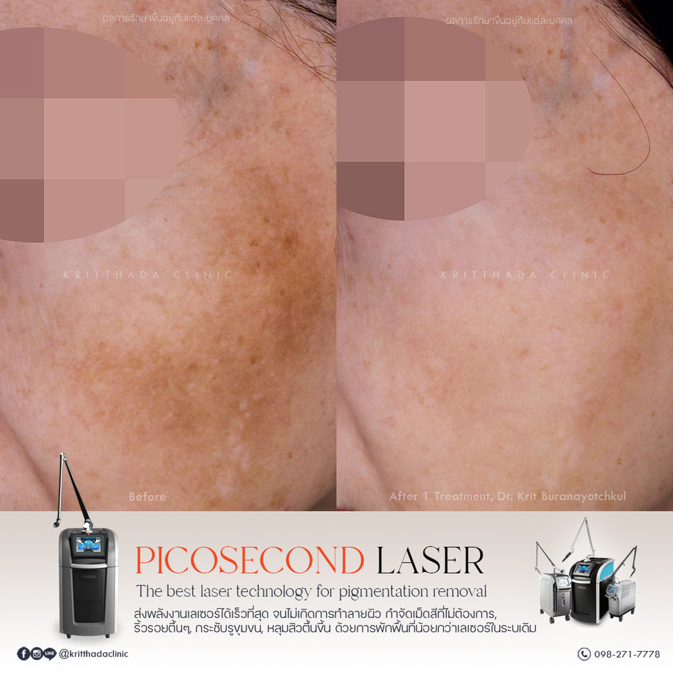 รีวิวรักษาฝ้า PicoSure Pro ก่อนและหลังทำที่ Kritthada Clinic เห็นผลลัพธ์ฝ้าจางลงชัดเจน