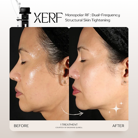 รีวิว XERF ยกกระชับปรับรูปหน้าให้ละมุน 2 คลื่นความถี่ Kritthada Clinic บางนา