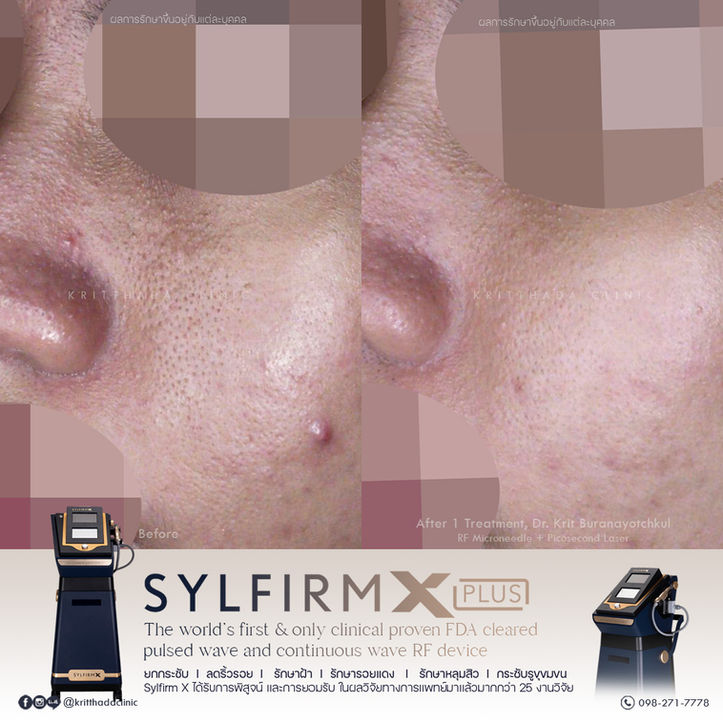 รีวิว Sylfirm X รักษาหลุมสิว