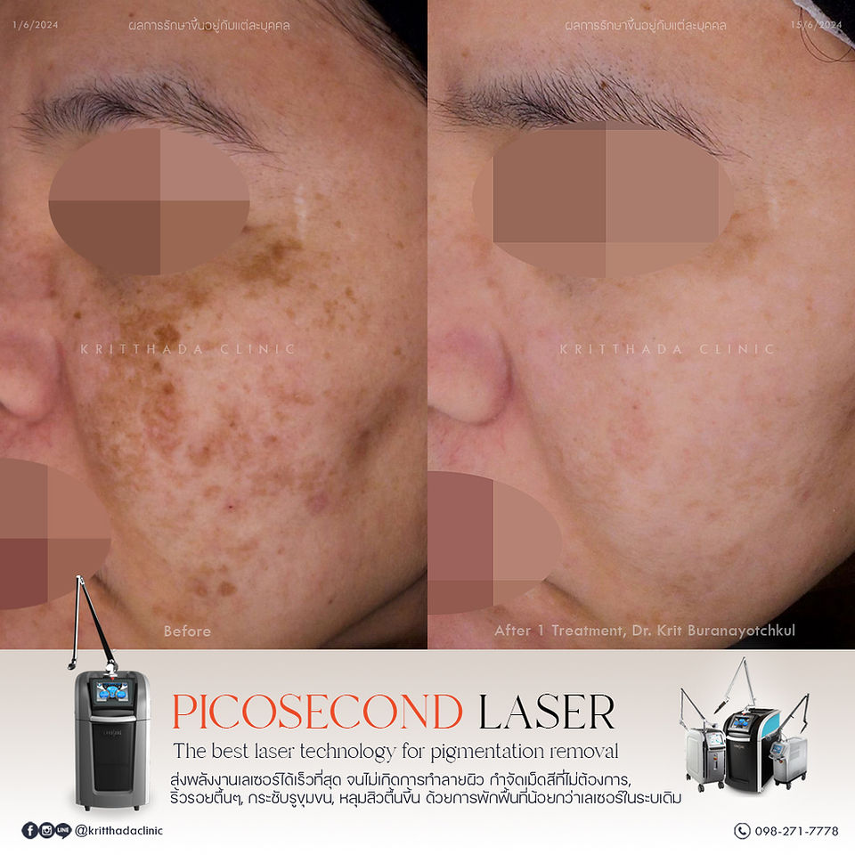 picosure pro เลเซอร์รักษาฝ้า ก่อนและหลัง 1 ครั้ง กริตธาดาคลินิก