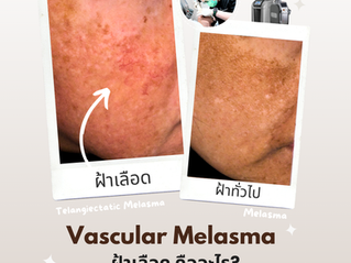 ฝ้าเลือด คืออะไร? เจาะลึกสาเหตุ ส่องลักษณะอาการและวิธีรักษาฝ้าเลือด อัปเดตปี 2026