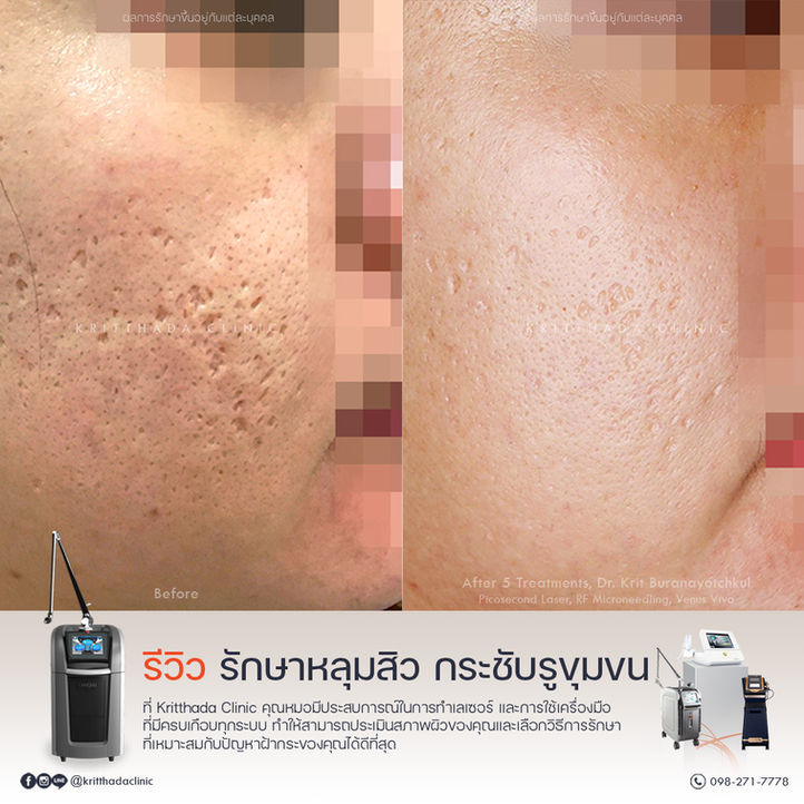 รีวิว รักษาหลุมสิว Kritthada Clinic