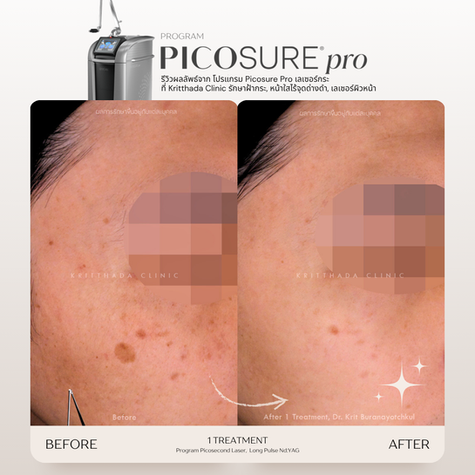 รีวิวรักษากระตื้นด้วยเลเซอร์ PicoSure Pro หลังทำ 1 ครั้ง โดยแพทย์ผู้ชำนาญการ Kritthada Clinic