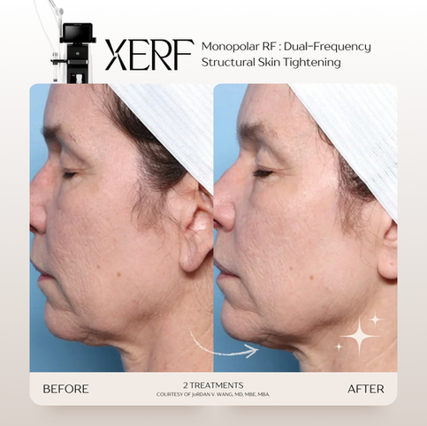 รีวิว XERF คืออะไร? ราคาเท่าไหร่? ทำที่ไหนดี