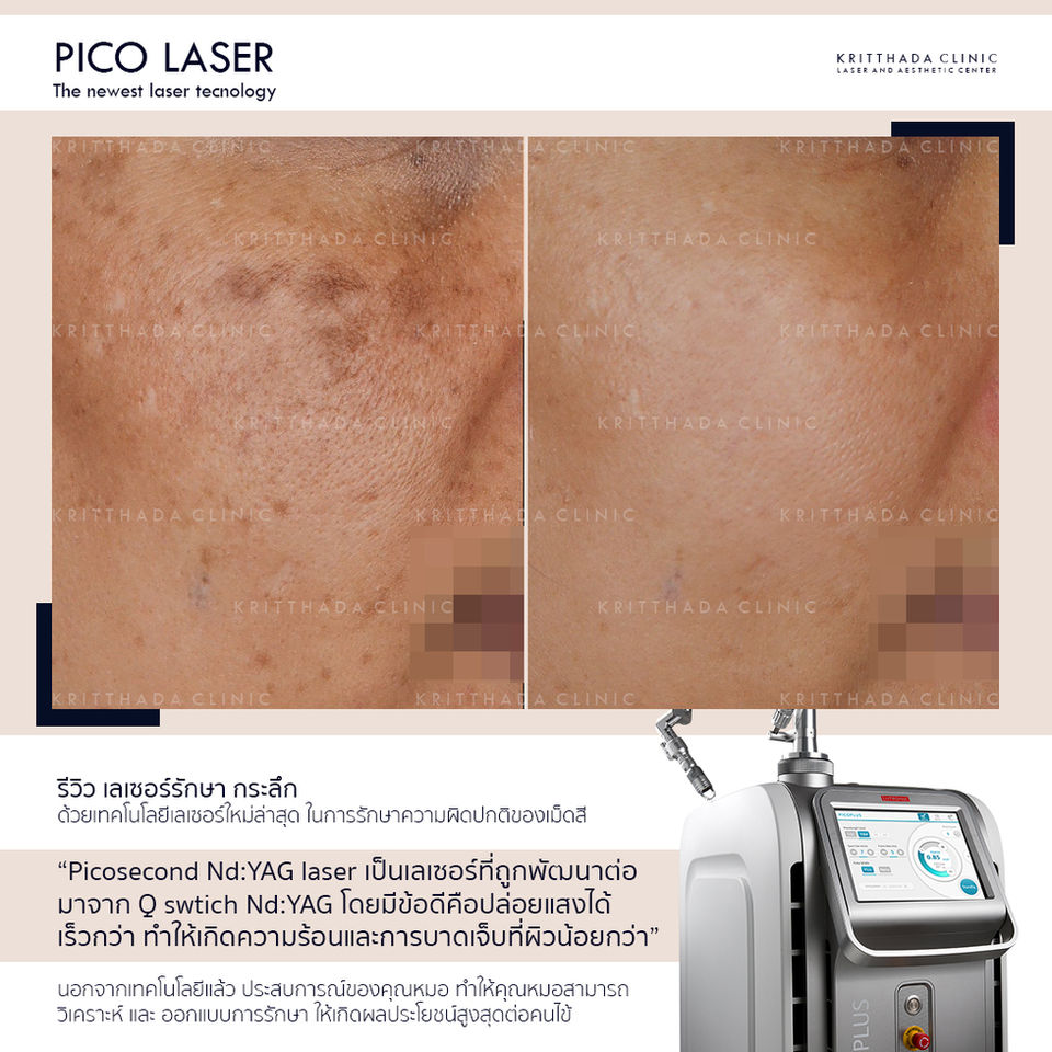 รีวิว รักษาฝ้า กระลึก Picosure Pro