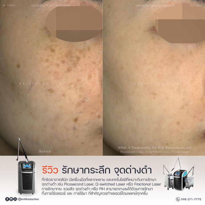 รีวิวรักษากระลึกบริเวณโหนกแก้ม ก่อนและหลังทำ Picosure Pro ที่กริตธาดาคลินิก ผลลัพธ์หลังทำ