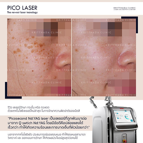 รีวิว pico เลเซอร์ กระ กระตื้น กระแดด