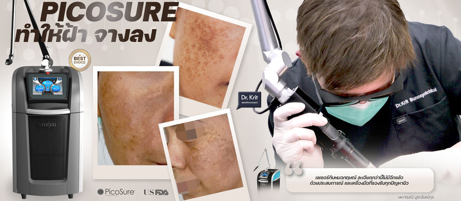 Pico Laser รักษาฝ้า ดีไหม? ที่ไหนดี?