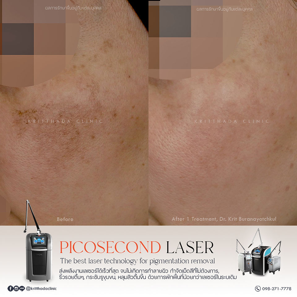 เลเซอร์ picosure pro รักษาฝ้าลึก ก่อน-หลัง ด้านข้าง กริตธาดาคลินิก