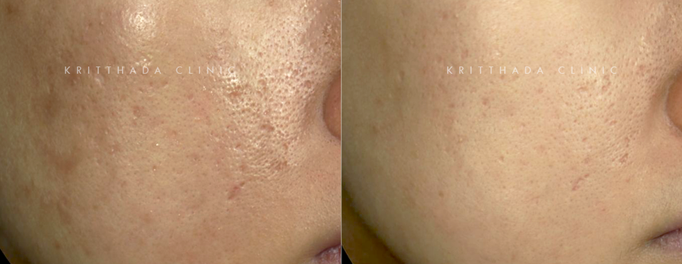 รีวิวรักษาหลุมสิวด้วย CureJet Juvelook ก่อนและหลังทำ ผิวเรียบเนียนขึ้นชัดเจน