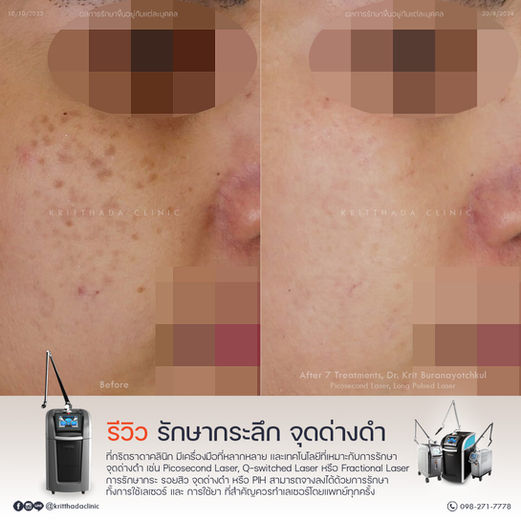 รักษากระลึก Nevus of Hori ด้วย Pico Laser ที่ Kritthada Clinic
