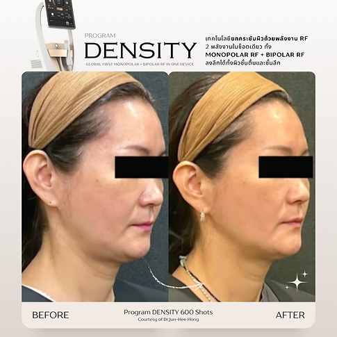 ผลลัพธ์ DENSITY RF ยก